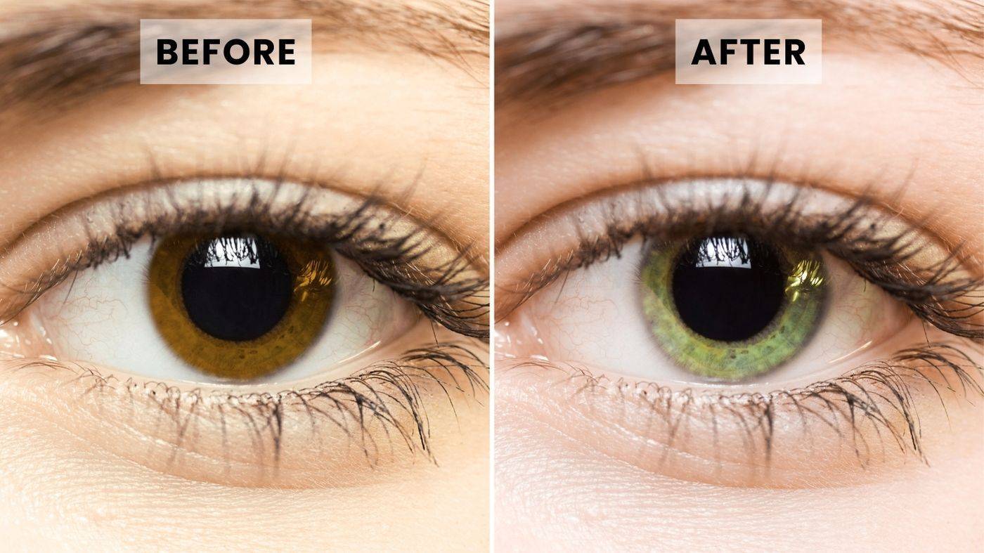 glutathione eye drops eye color change changes with glaucoma treatment 10ml Color Changing Eye Drops,