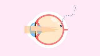 Cross section diagram of an eye showing light rays focusing at multiple points on the retina.