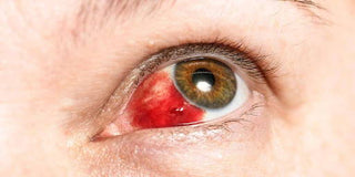 Bleeding in the Eye: Everything You Need to Know About Subconjunctival Hemorrhage