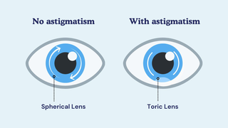 Diagram comparing a spherical lens for eyes without astigmatism to a toric lens for eyes with astigmatism.