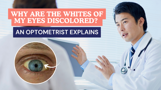 Why Are the Whites of My Eyes Discolored? An Optometrist Explains